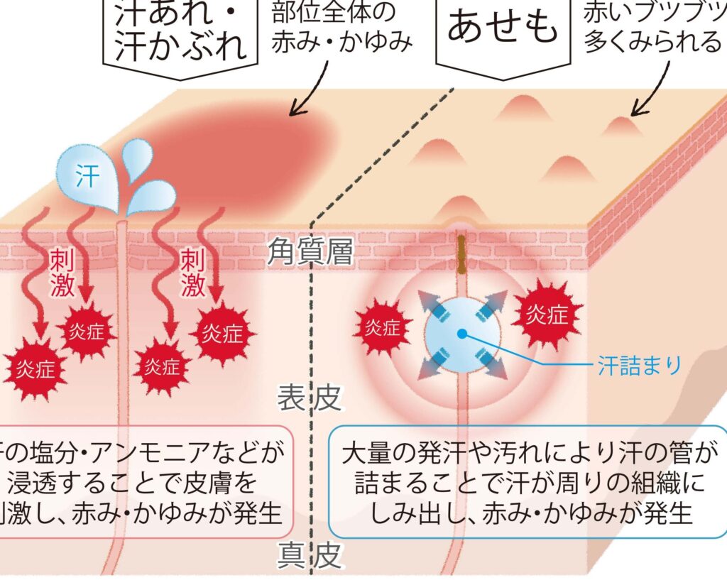 汗塩を吹く病気の症状と原因、治療法一覧